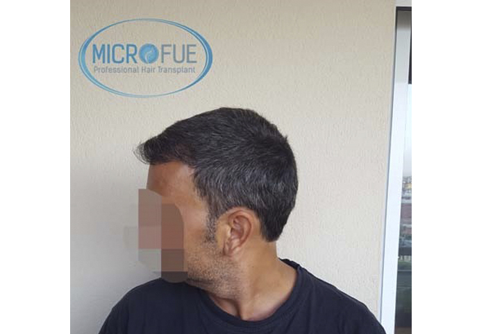 foto trasplante pelo microfue foto trasplante pelo microfue