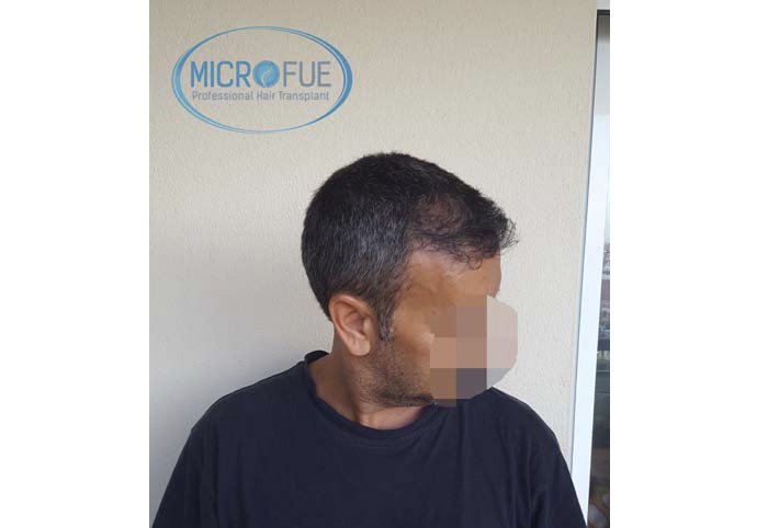 foto trasplante pelo microfue foto trasplante pelo microfue