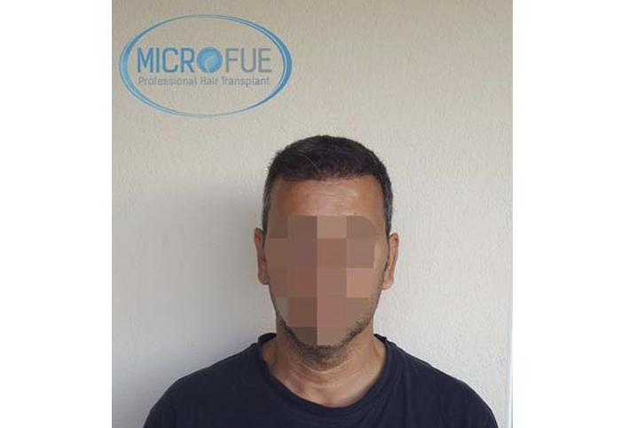 foto trasplante pelo microfue foto trasplante pelo microfue