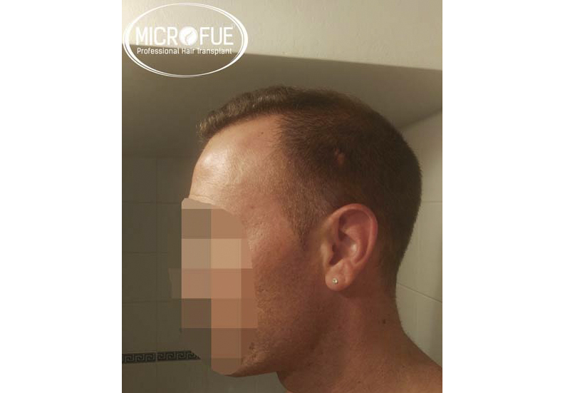 Trasplante capilar con Microfue Trasplante capilar con Microfue