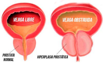 finasteride 5 mg para que se utiliza