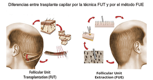 diferencias trasplante capilar FUE y FUT