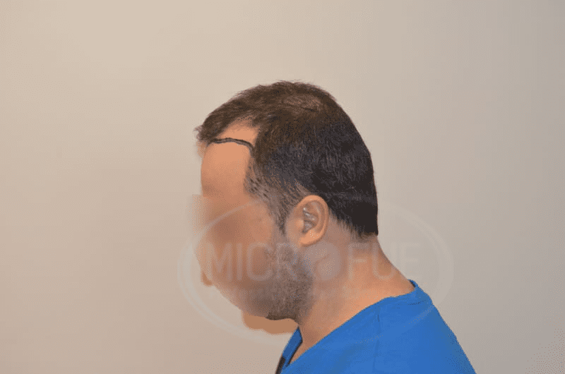 Fotos de resultados injerto capilar en Turquía Fotos de resultados injerto capilar en Turquía
