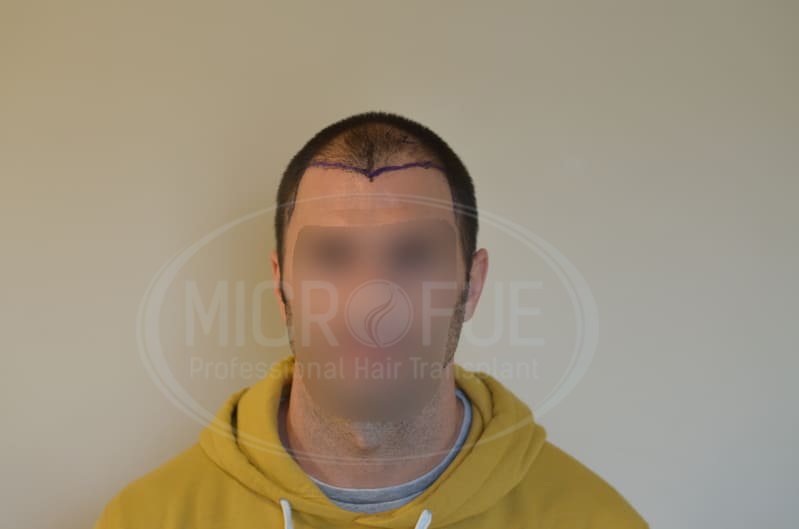 fotos_resultado_injerto_capilar_Turquía_Microfue_15 fotos_resultado_injerto_capilar_Turquía_Microfue_15