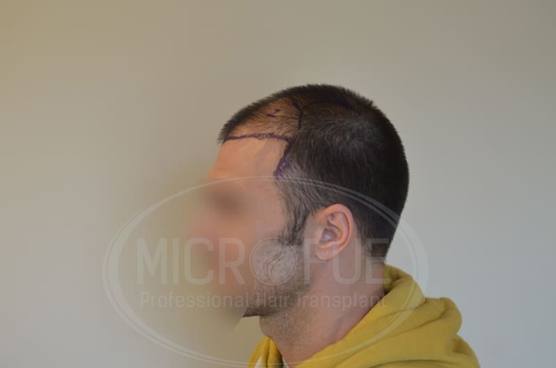 fotos_resultado_trasplante_pelo_Turquía_Microfue_036_z_ fotos_resultado_trasplante_pelo_Turquía_Microfue_036_z_