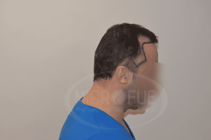 Fotos de resultados injerto capilar en Turquía Fotos de resultados injerto capilar en Turquía