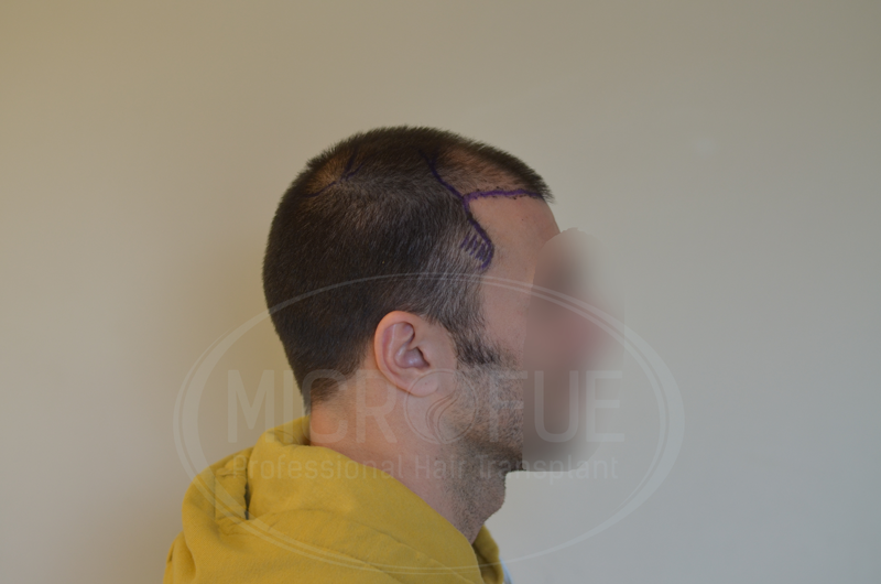 fotos_resultado_injerto_capilar_Turquía_Microfue_04 fotos_resultado_injerto_capilar_Turquía_Microfue_04