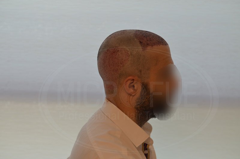 fotos_resultados__trasplante_capilar_Turquia_38_13 fotos_resultados__trasplante_capilar_Turquia_38_13