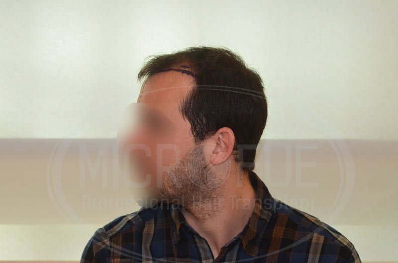 fotos_resultados_trasplante_capilar_Turquia_MicroFue_037_04. fotos_resultados_trasplante_capilar_Turquia_MicroFue_037_04.