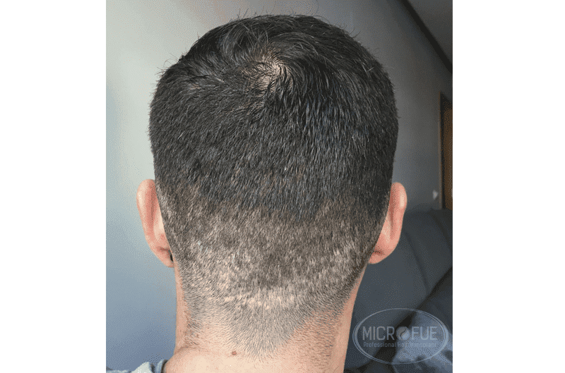 fotos_resultados_trasplante_capilar_Turquía_Microfue_33-1 fotos_resultados_trasplante_capilar_Turquía_Microfue_33-1