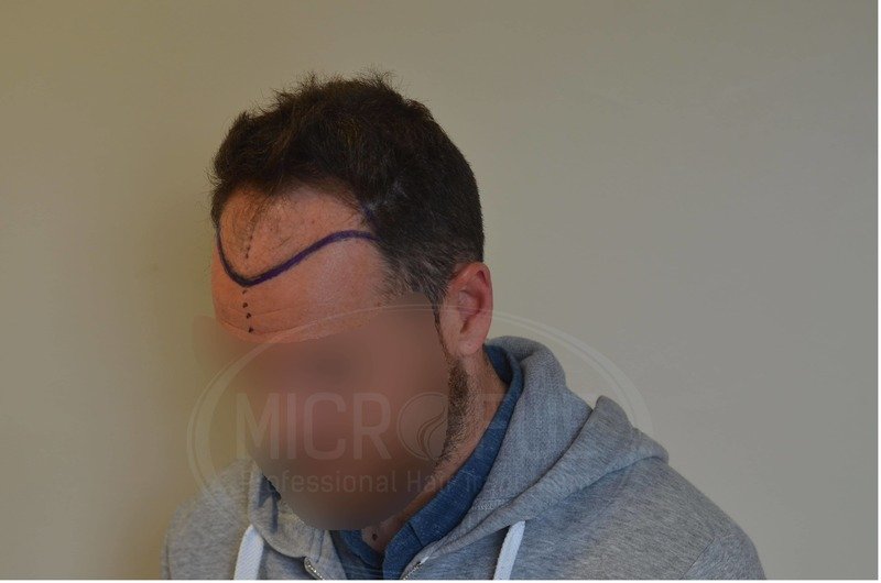 Resultados de trasplante capilar en turquia microfue Resultados de trasplante capilar en turquia microfue