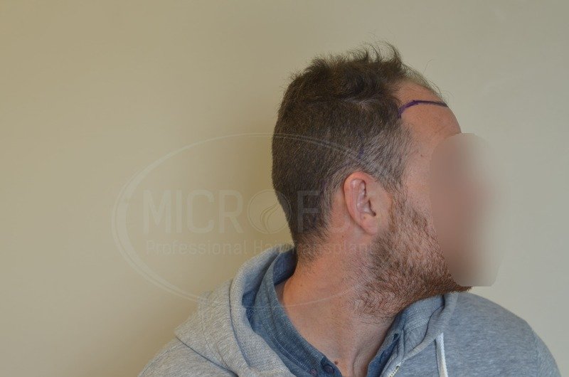 Resultados de trasplante capilar en turquia microfue Resultados de trasplante capilar en turquia microfue