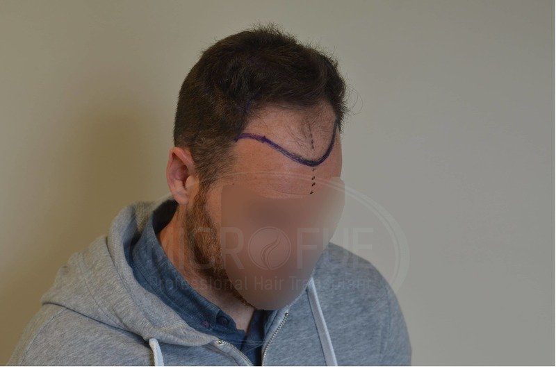 Resultados de trasplante capilar en turquia microfue Resultados de trasplante capilar en turquia microfue