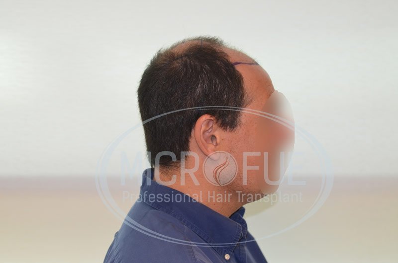 fotos_trasplante_capilar_turquia_resultados_39_5 fotos_trasplante_capilar_turquia_resultados_39_5