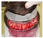 incision_FUT_trasplante_pelo