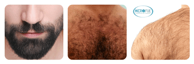 trasplante pelo corporal Body Hair Transplant Microfue