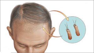 trasplante_capilar_Microfue_en_que_consiste trasplante_capilar_Microfue_en_que_consiste