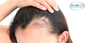 alopecia_androgenica_femenina_trasplante_capilar_Turquia alopecia androgénica femenina trasplante capilar Turquía