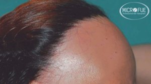 alopecia_frontal_fibrosante_trasplante_capilar_Turquia alopecia frontal fibrosante