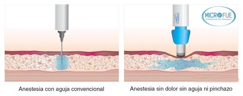 anestesia sin dolor en trasplante capilar