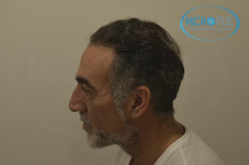 fotos_resultados_trsplante_de_pelo_turquia_Microfue_FUE_10 fotos_resultados_trsplante_de_pelo_turquia_Microfue_FUE_10