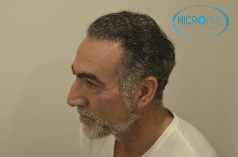 fotos_resultados_trsplante_de_pelo_turquia_Microfue_FUE_11 fotos_resultados_trsplante_de_pelo_turquia_Microfue_FUE_11