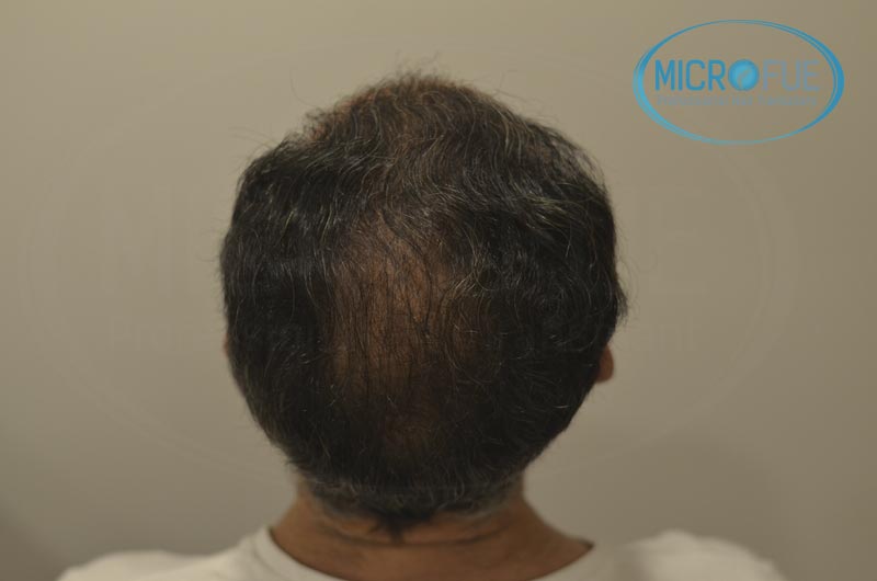 fotos_resultados_trsplante_de_pelo_turquia_Microfue_FUE_2 fotos_resultados_trsplante_de_pelo_turquia_Microfue_FUE_2