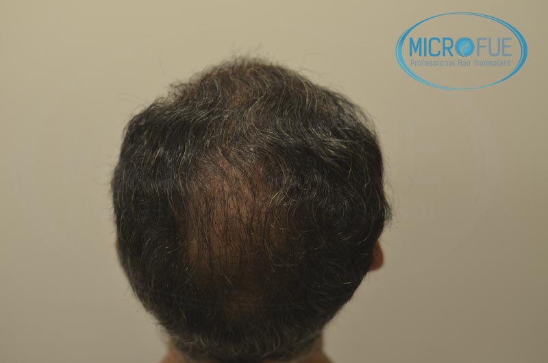fotos_resultados_trsplante_de_pelo_turquia_Microfue_FUE_3 fotos_resultados_trsplante_de_pelo_turquia_Microfue_FUE_3