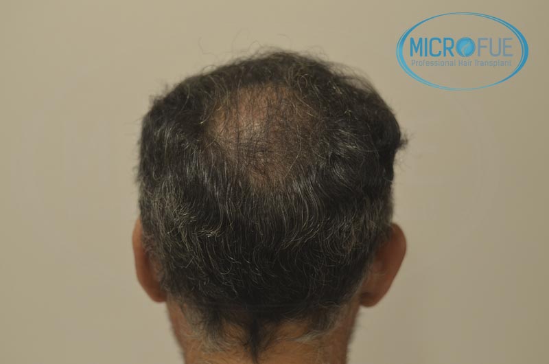 fotos_resultados_trsplante_de_pelo_turquia_Microfue_FUE_5 fotos_resultados_trsplante_de_pelo_turquia_Microfue_FUE_5