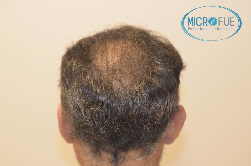 fotos_resultados_trsplante_de_pelo_turquia_Microfue_FUE_6 fotos_resultados_trsplante_de_pelo_turquia_Microfue_FUE_6