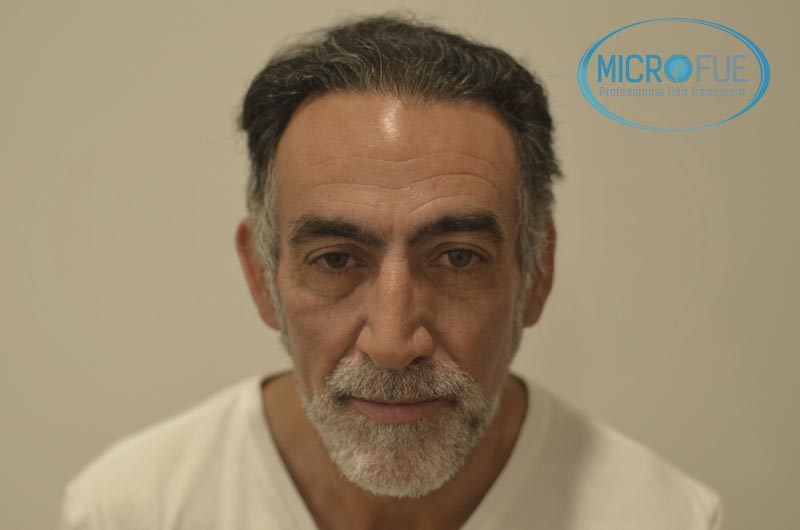 fotos_resultados_trsplante_de_pelo_turquia_Microfue_FUE_7 fotos_resultados_trsplante_de_pelo_turquia_Microfue_FUE_7