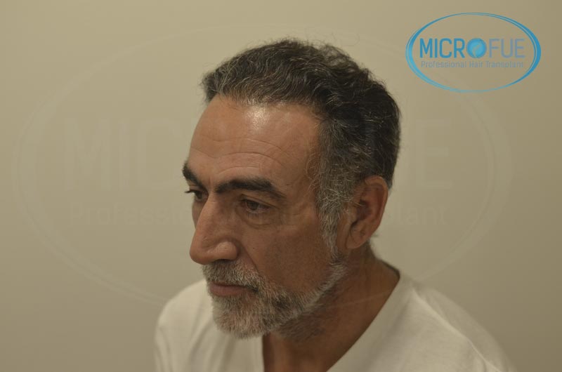 fotos_resultados_trsplante_de_pelo_turquia_Microfue_FUE_8 fotos_resultados_trsplante_de_pelo_turquia_Microfue_FUE_8