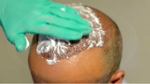Come lavare i capelli dopo il trapianto di capelli in Turchia con Microfue