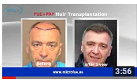 milinko pantic injerto capilar Microfue