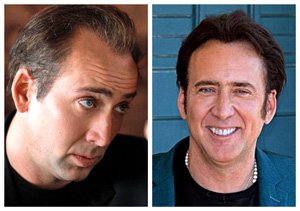 nicolas cage trasplante capilar