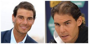 rafael nadal trasplante de pelo Microfue