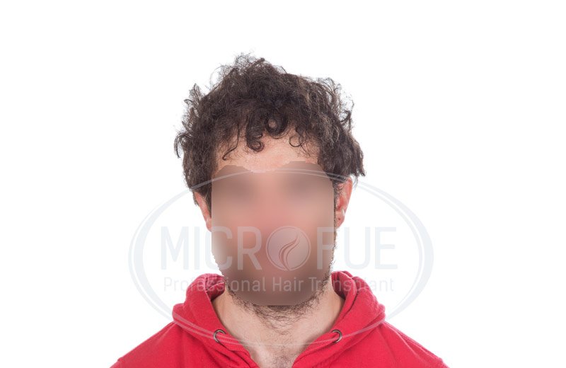 resultado_trasplante_capilar_turquia_microfue_11 resultado_trasplante_capilar_turquia_microfue_11