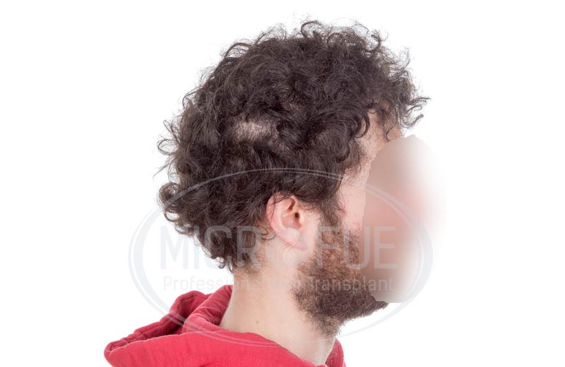 resultado_trasplante_capilar_turquia_microfue_12 resultado_trasplante_capilar_turquia_microfue_12