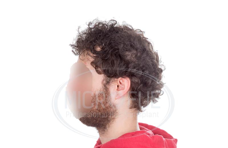 resultado_trasplante_capilar_turquia_microfue_13 resultado_trasplante_capilar_turquia_microfue_13