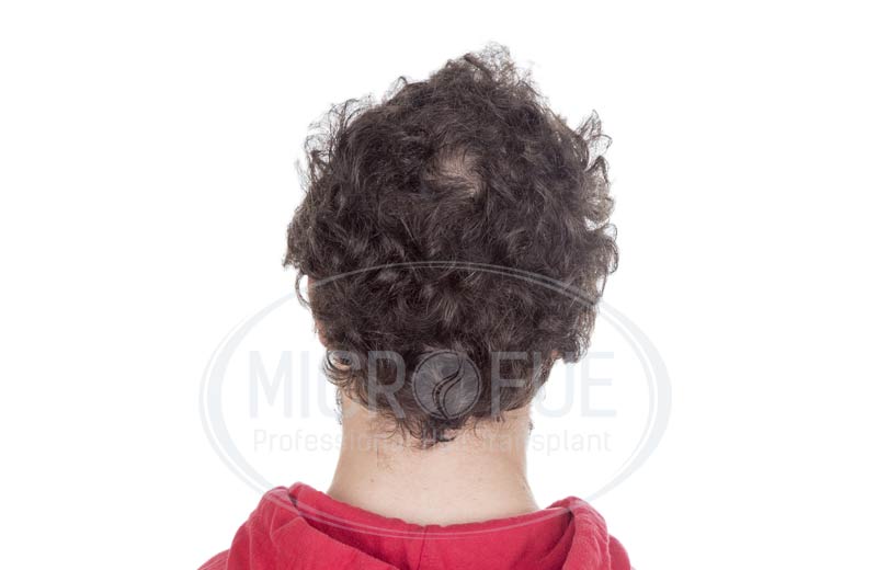 resultado_trasplante_capilar_turquia_microfue_14 resultado_trasplante_capilar_turquia_microfue_14