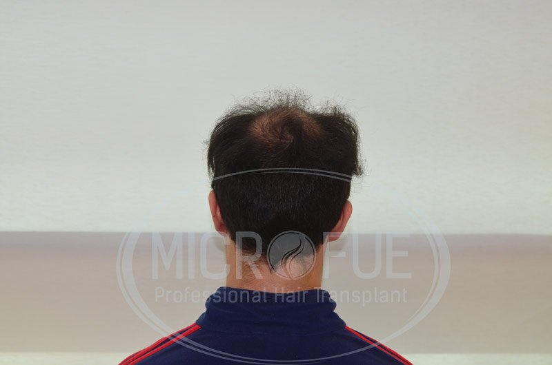 resultado_trasplante_capilar_turquia_microfue_5 resultado_trasplante_capilar_turquia_microfue_5