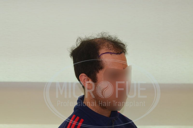 resultado_trasplante_capilar_turquia_microfue_6 resultado_trasplante_capilar_turquia_microfue_6