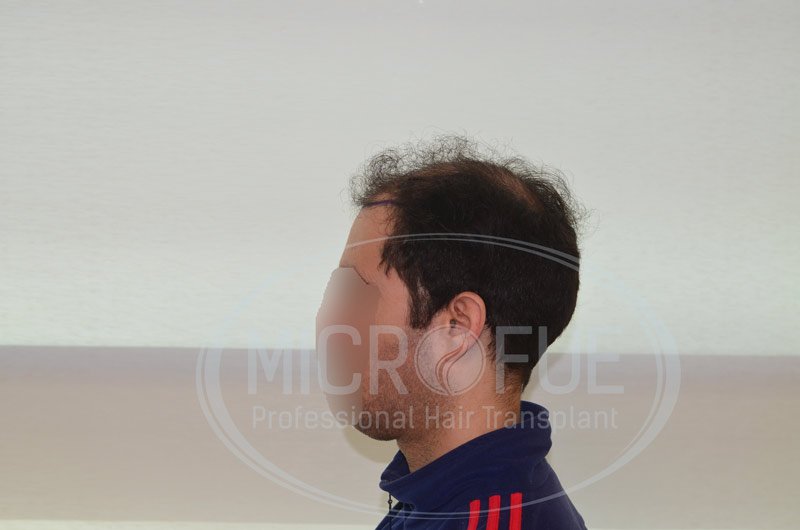 resultado_trasplante_capilar_turquia_microfue_7 resultado_trasplante_capilar_turquia_microfue_7