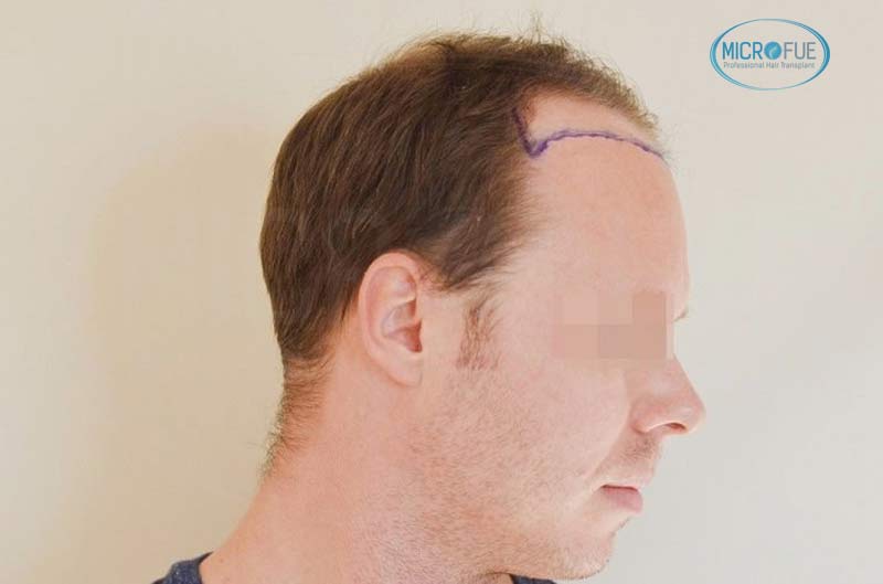 resultado_trasplante_pleo_capilar_Turquia_FUE_Microfue_04 resultado_trasplante_pleo_capilar_Turquia_FUE_Microfue_04