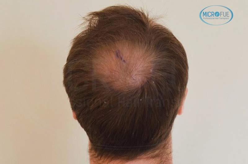 resultado_trasplante_pleo_capilar_Turquia_FUE_Microfue_05 resultado_trasplante_pleo_capilar_Turquia_FUE_Microfue_05