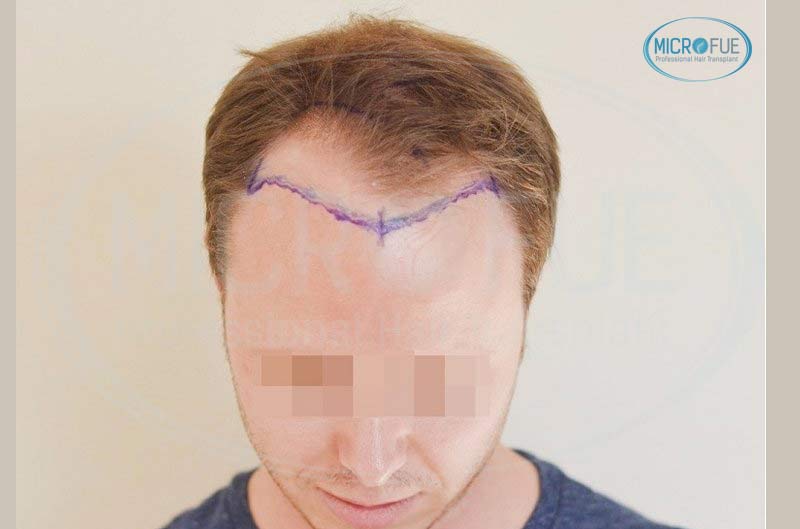 resultado_trasplante_pleo_capilar_Turquia_FUE_Microfue_07 resultado_trasplante_pleo_capilar_Turquia_FUE_Microfue_07