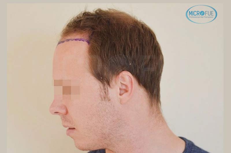 resultado_trasplante_pleo_capilar_Turquia_FUE_Microfue_08 resultado_trasplante_pleo_capilar_Turquia_FUE_Microfue_08