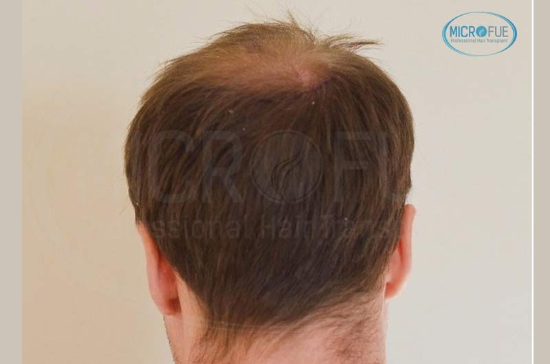 resultado_trasplante_pleo_capilar_Turquia_FUE_Microfue_10 resultado_trasplante_pleo_capilar_Turquia_FUE_Microfue_10
