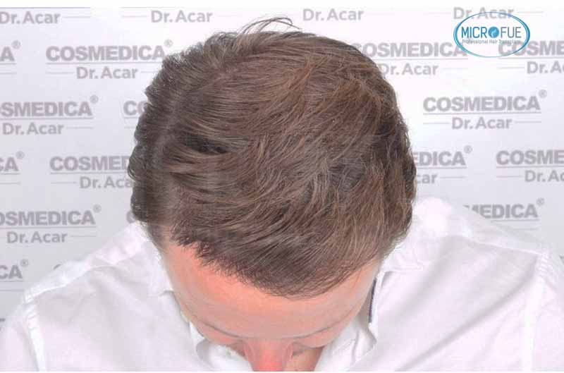 resultado_trasplante_pleo_capilar_Turquia_FUE_Microfue_11 resultado_trasplante_pleo_capilar_Turquia_FUE_Microfue_11