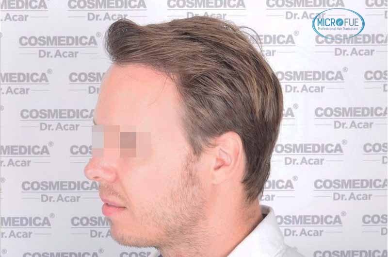 resultado_trasplante_pleo_capilar_Turquia_FUE_Microfue_12 resultado_trasplante_pleo_capilar_Turquia_FUE_Microfue_12